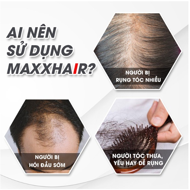           Viên uống mọc tóc  Maxxhair dùng được cho cả Nam và Nữ bị rụng tóc, hói