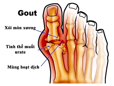 Các dấu hiệu bệnh gout