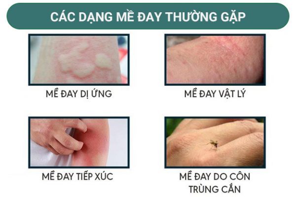 cac-dang-di-ưng-noi-me-day-thuong-gap